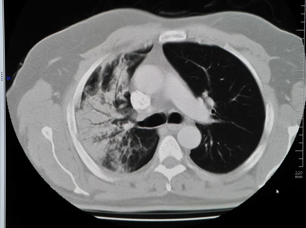 Ct płuc — Zdjęcie stockowe