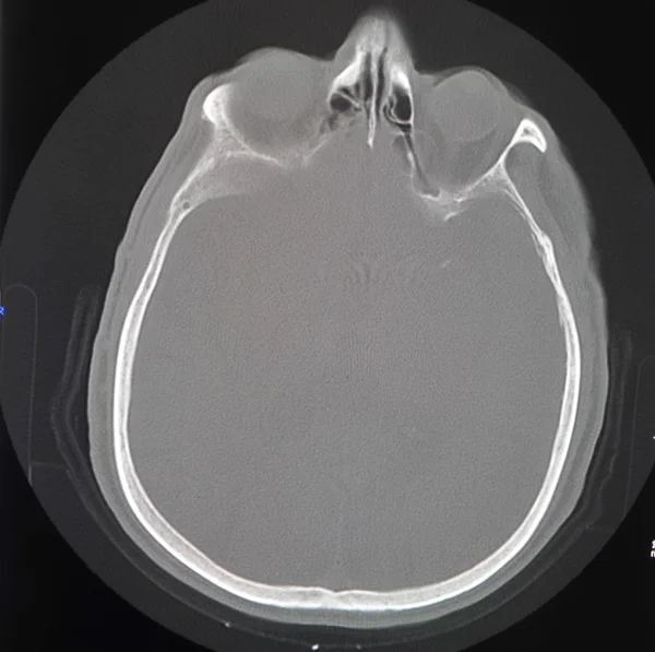 Tomografia mózgu — Zdjęcie stockowe