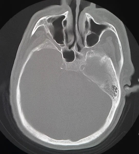 Tomografia mózgu — Zdjęcie stockowe