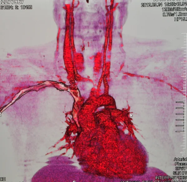 Coronary angiography Stock Image