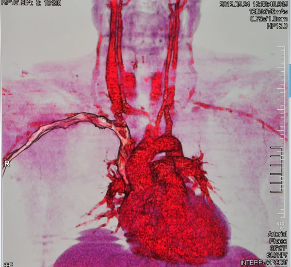 冠動脈造影 ストック画像