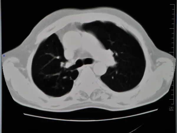Ct płuc Obrazek Stockowy