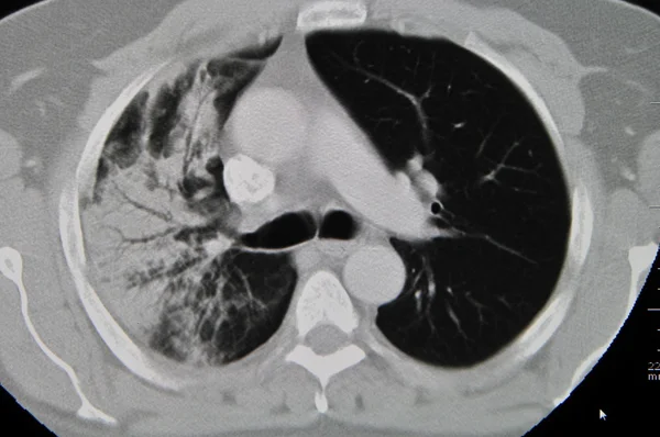 Lung ct Royalty Free Stock Images