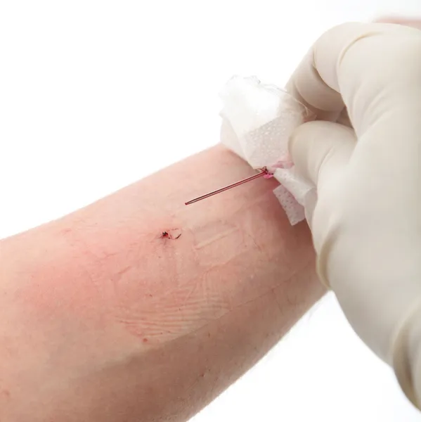 Intravenöse Nadel aus Vene entnommen — Stockfoto