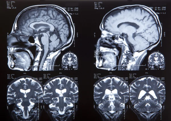 MRI van menselijke hersenen — Stockfoto