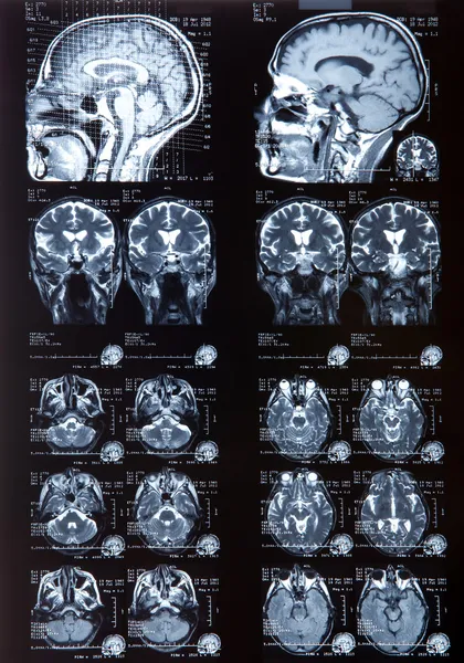 stock image MRI of human brain