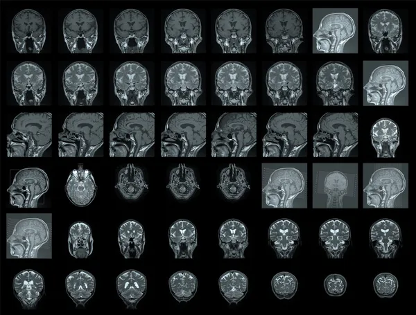 Μαγνητική τομογραφία του ανθρώπινου εγκεφάλου — Φωτογραφία Αρχείου