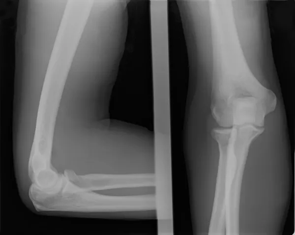 X-ray kép törött könyök — Stock Fotó