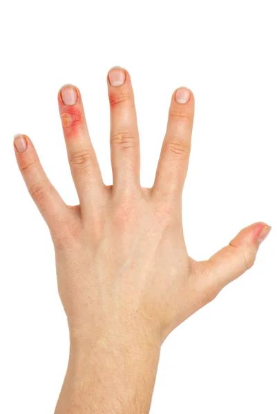 Ладонь с поврежденными пальцами — стоковое фото
