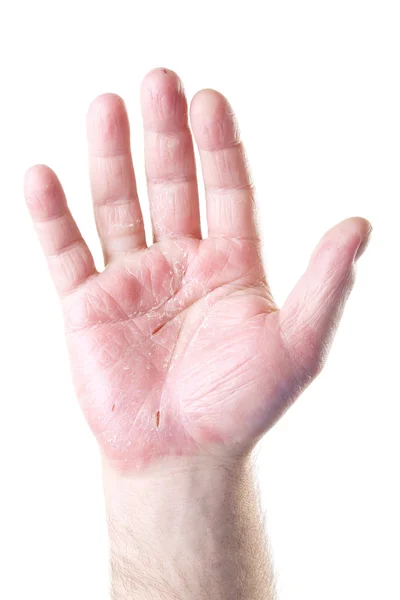 Männliche Handfläche mit Ekzemen isoliert auf weißem Hintergrund — Stockfoto