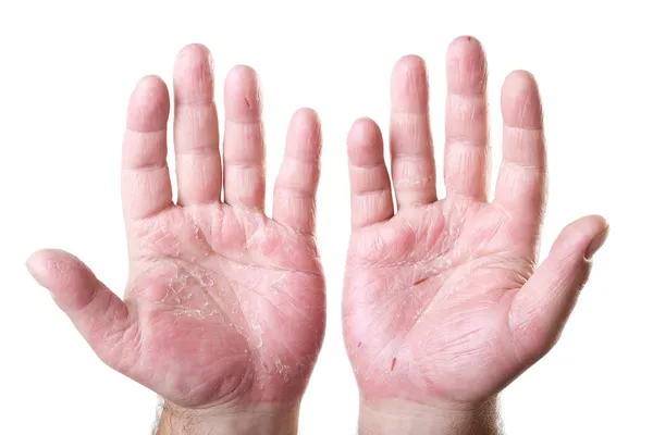 Duas palmas masculinas com eczema isolado sobre fundo branco — Fotografia de Stock