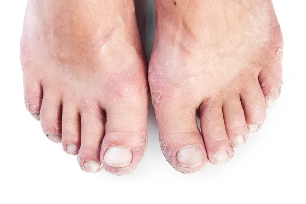 Due piedi maschili con eczema isolato su sfondo bianco — Foto Stock