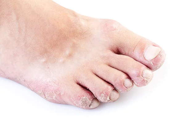 Einzelner männlicher Fuß mit Ekzemen isoliert auf weißem Hintergrund — Stockfoto