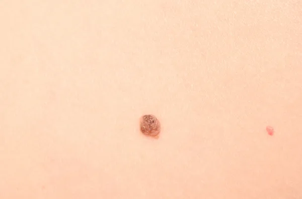 Mole on skin — Stock Photo, Image