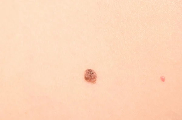 Mole on skin — Stock Photo, Image