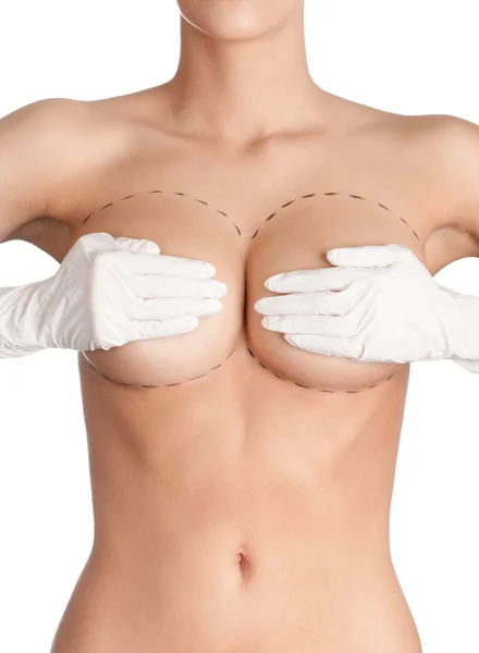 Umrissene Teile der Brust, die einer plastischen Korrektur bedürfen — Stockfoto