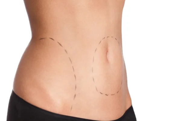 Belly plastic correction, side view — Stock Photo, Image