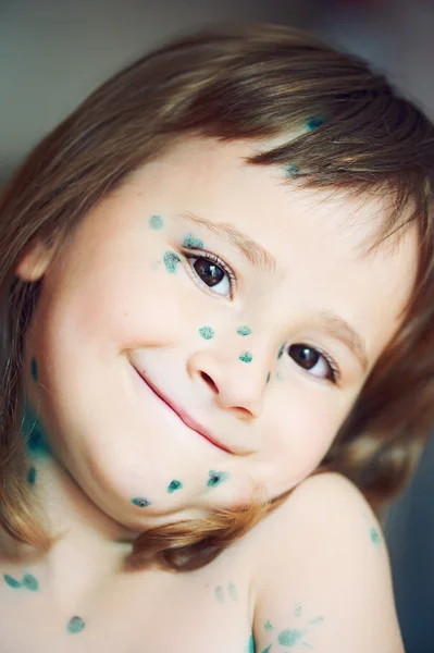 Petite fille avec la varicelle — Photo