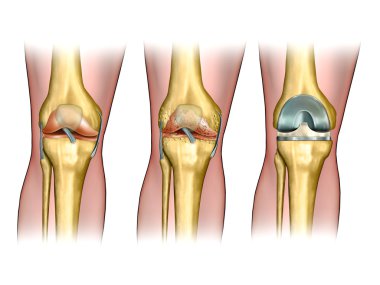 Knee replacement clipart