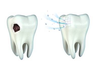Teeth cavity clipart