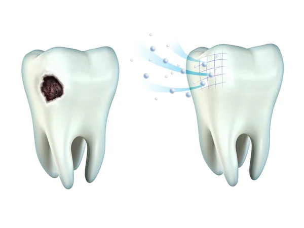 Teeth cavity — Stock Photo, Image