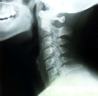 X-rays of woman's neck clipart