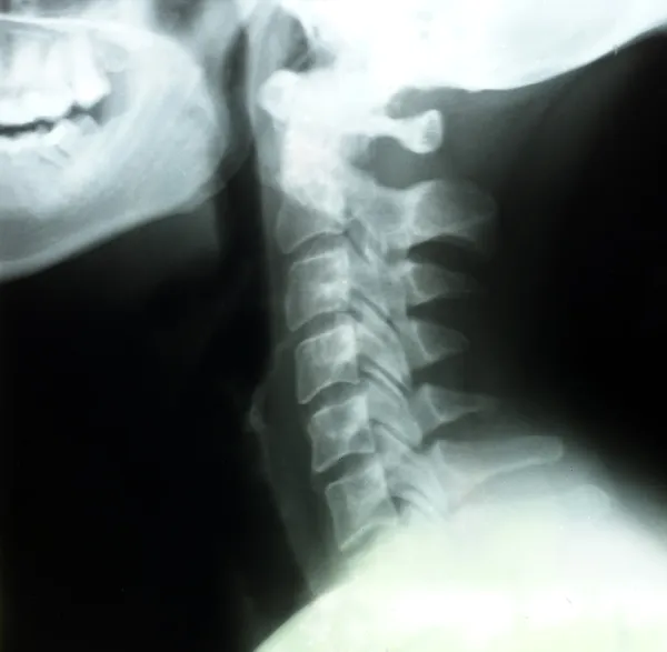 Röntgen av kvinnans hals — Stockfoto