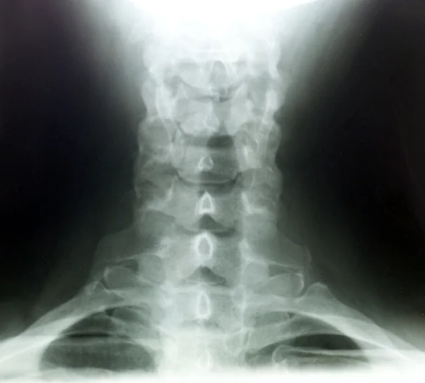 Röntgenbilder des Nackenrückens — Stockfoto