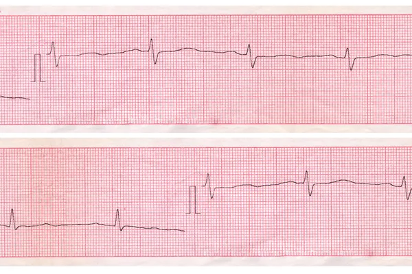 Cardiogramma. Schema di analisi cardiaca — Foto Stock