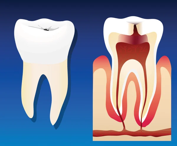 Ohälsosamma tand — Stock vektor