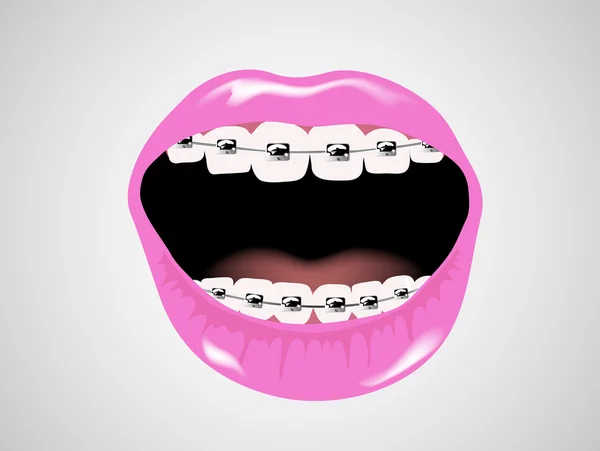 Zahnspange — Stockvektor