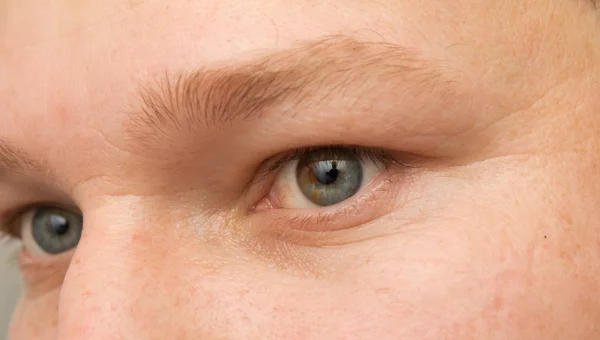 Глаз с родимым пятном — стоковое фото
