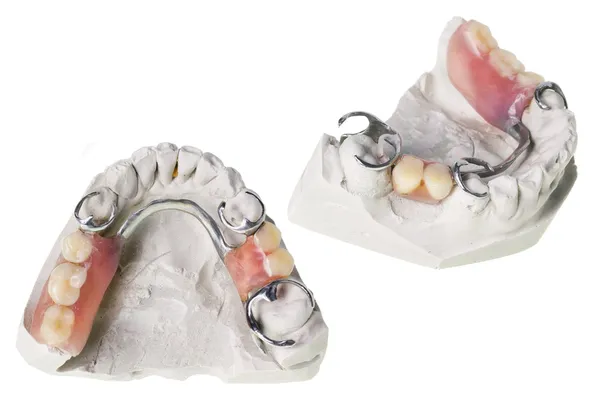 牙齿和假牙的石膏 — 图库照片