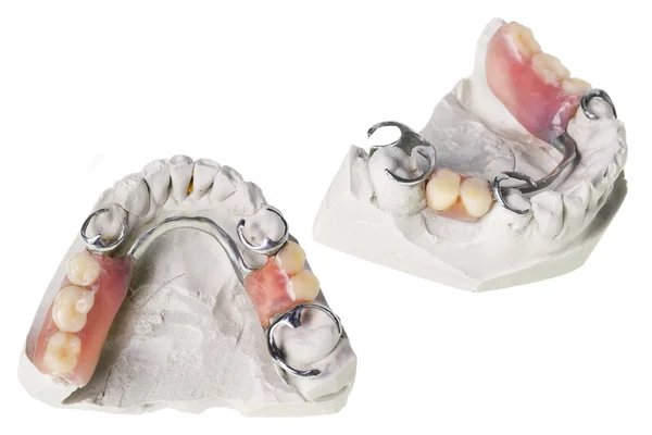 歯と義歯のギプス ストック写真