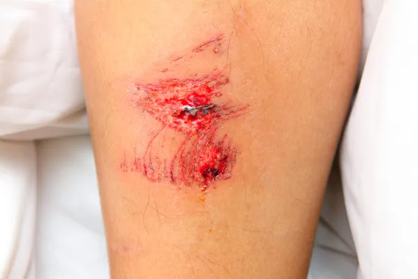 Рана на ноге — стоковое фото