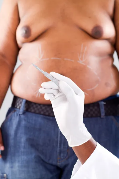 Plastic surgery for overweight african american — Stock Photo, Image