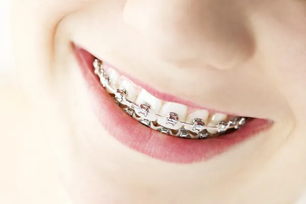 Lächeln mit Zahnspange — Stockfoto