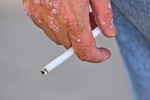Person mit Schuppenflechte an der Hand, hält eine brennende Zigarette zwischen den Fingern, Nahaufnahme — Stockfoto
