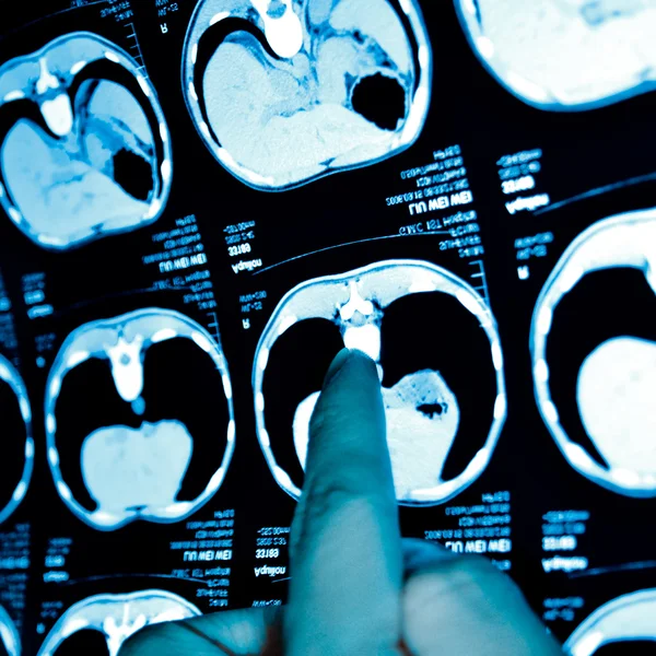Mostrando imagen de rayos X vértebra lumbar — Foto de Stock
