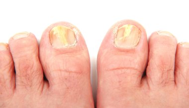 Toenails infected with a fungus clipart