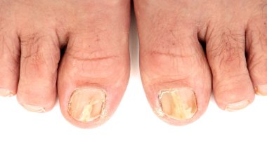 Toenails infected with a fungus clipart