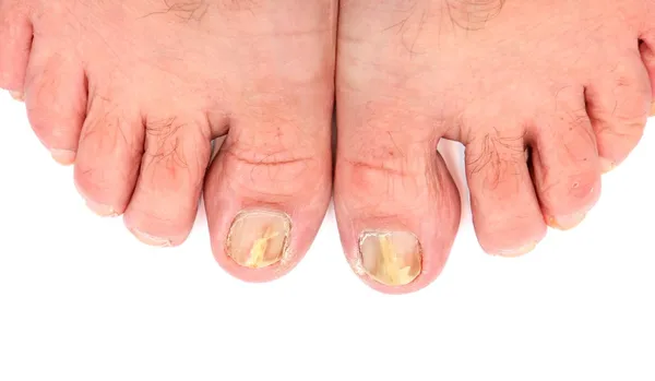 Toenails infected with fungus — Stock Photo, Image