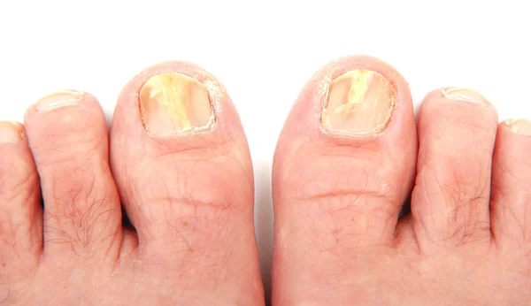 Unghie dei piedi infettate da un fungo — Foto Stock