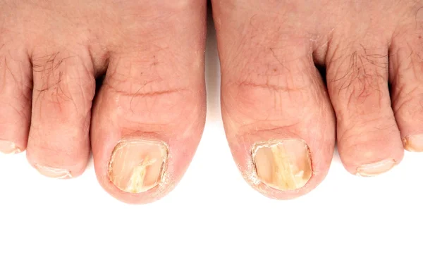 Toenails infected with a fungus — Stock Photo, Image