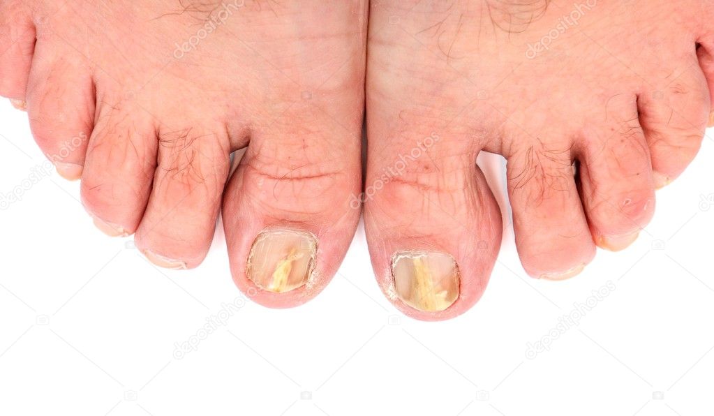 Toenails infected with fungus