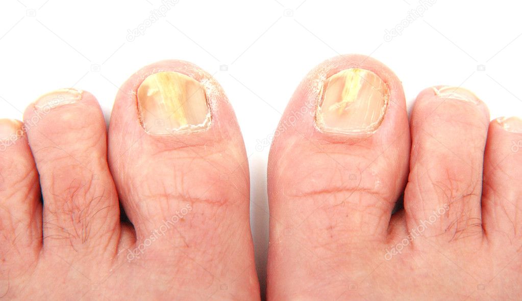gomba nail foot típusai)
