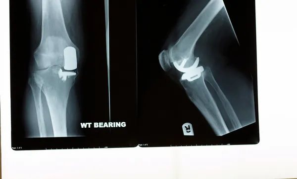 Una radiografia di una sostituzione del ginocchio — Foto Stock
