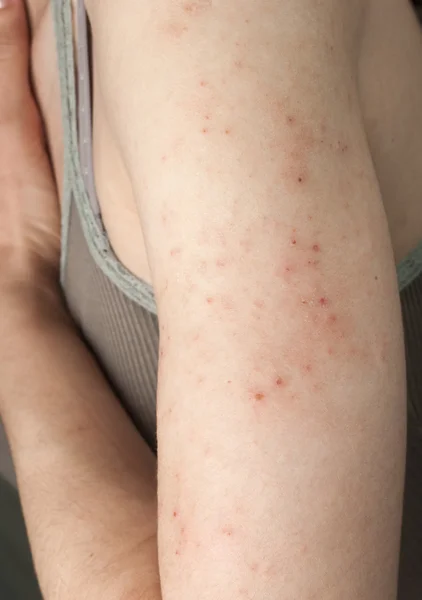 アレルギーの発疹性皮膚炎 — ストック写真