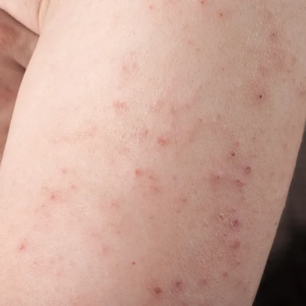 Dermatitis alérgica cutánea —  Fotos de Stock