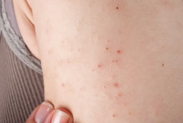 Dermatite alérgica cutânea — Fotografia de Stock
